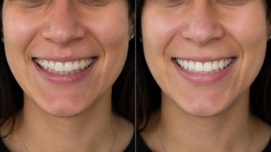 Before and after clear aligners results at Punta cana dentist odontologia familiar, improved smile