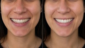 Before and after clear aligners results at Punta cana dentist odontologia familiar, improved smile