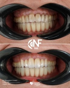 before-after photo no-prep-veneers