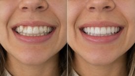 Before and after clear aligners result at Punta cana dentist odontologia familiar, improved smile