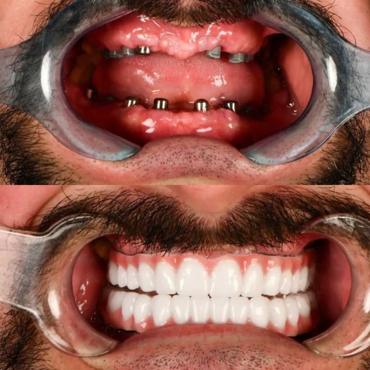 Resultados antes y después de prótesis de zirconia en Adalya Dental Clinic