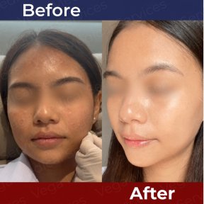 Before and after stem cell rejuvenation therapy at Vega Clinic – improved facial skin texture result