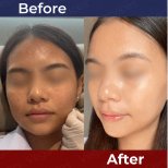 Before and after stem cell rejuvenation therapy at Vega Clinic – improved facial skin texture result
