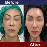Before and after stem cell rejuvenation therapy at Vega Clinic – visible anti-aging results