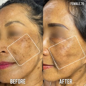 Before and after stem cell rejuvenation therapy result at Vega Clinic, improved skin texture