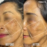 Before and after stem cell rejuvenation therapy result at Vega Clinic, improved skin texture