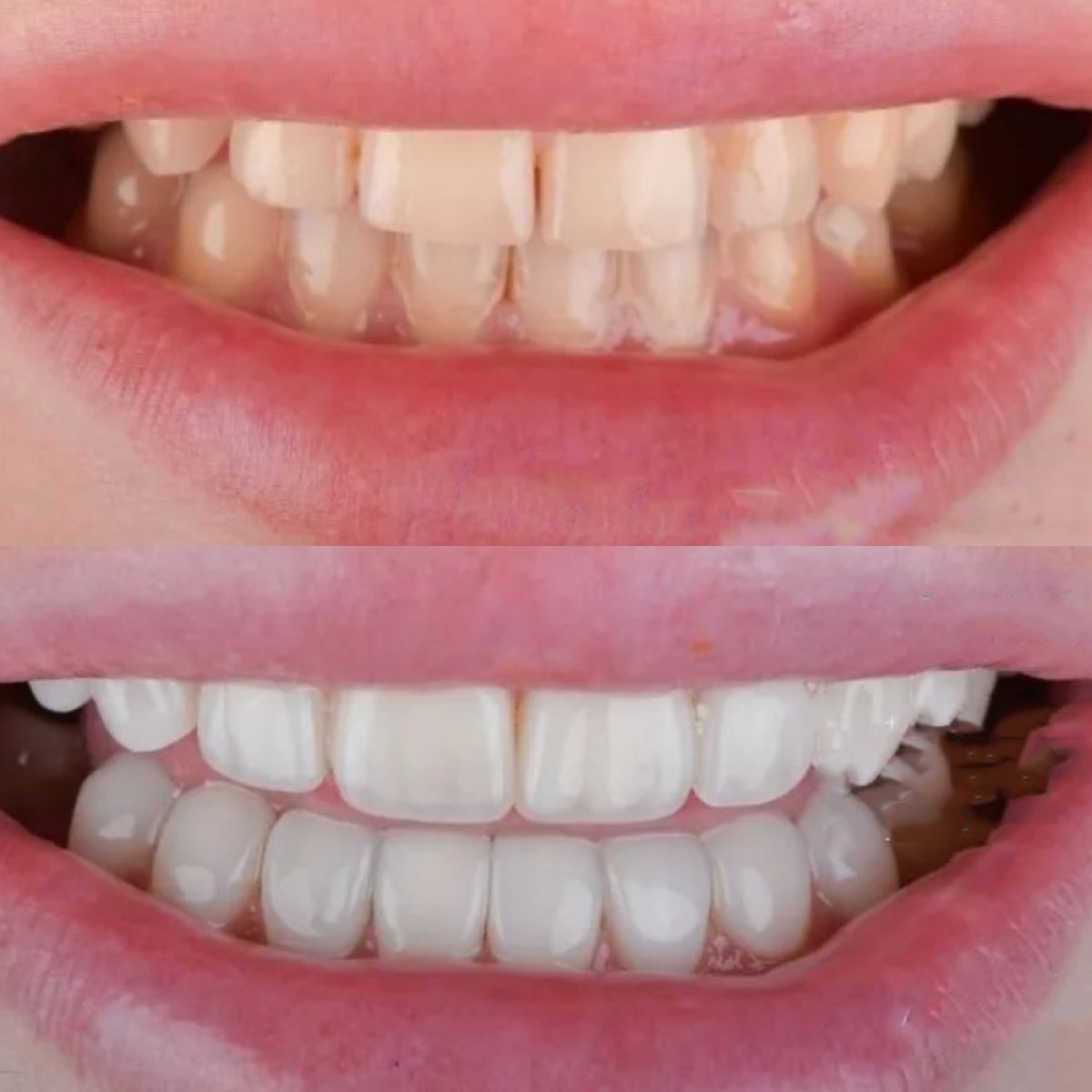 Resultados antes y después de empaste de composite en Adalya Dental Clinic para mejorar la sonrisa