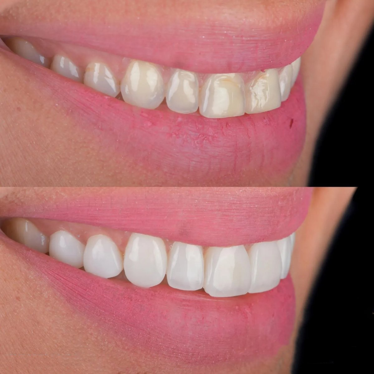 Resultados antes y después de relleno compuesto en Adalya Dental Clinic para restaurar la sonrisa