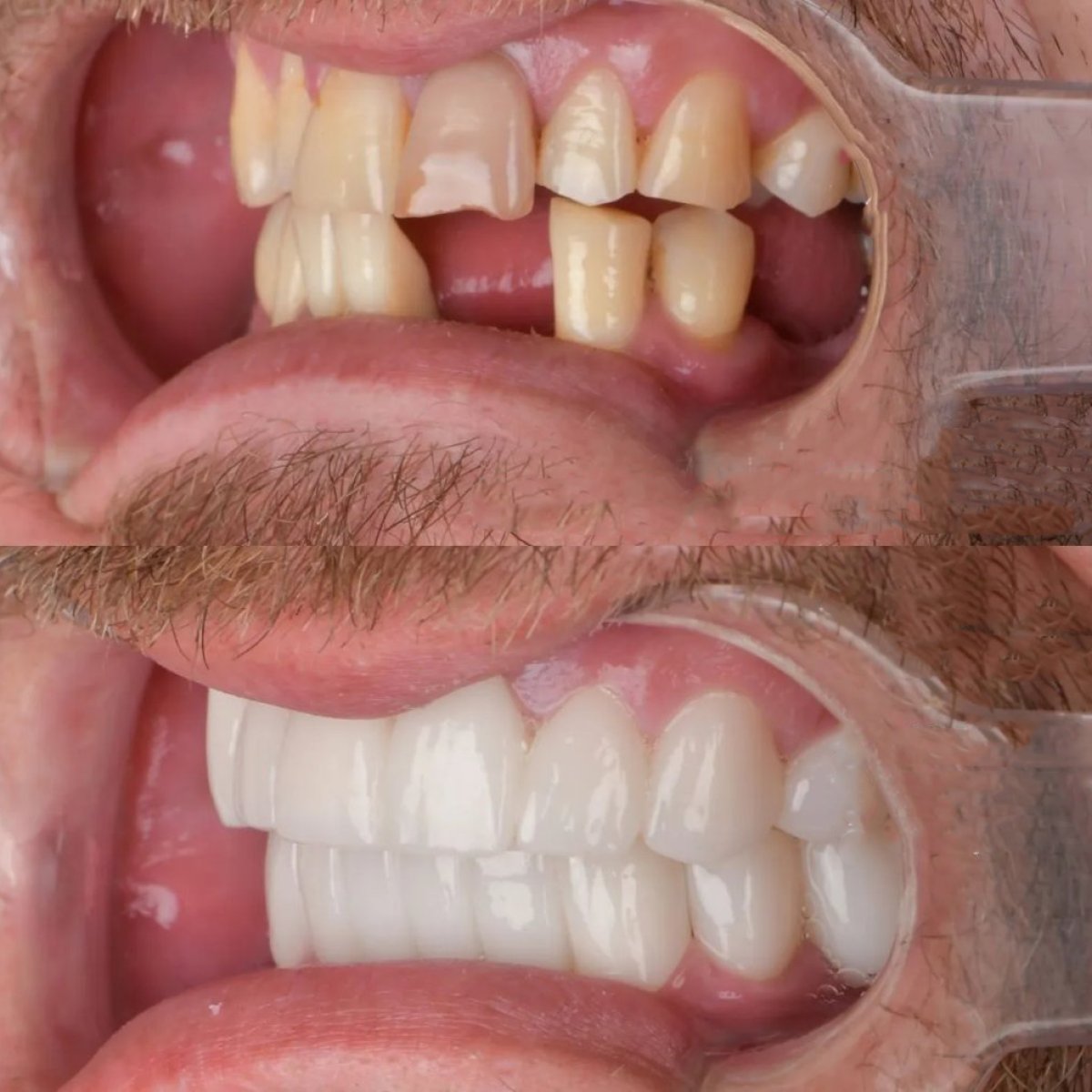 نتيجة قبل وبعد جسر الأسنان المدعوم بالزرعات في عيادة Adalya Dental Clinic
