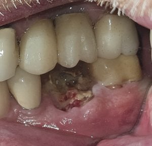 before-after photo dental-implant