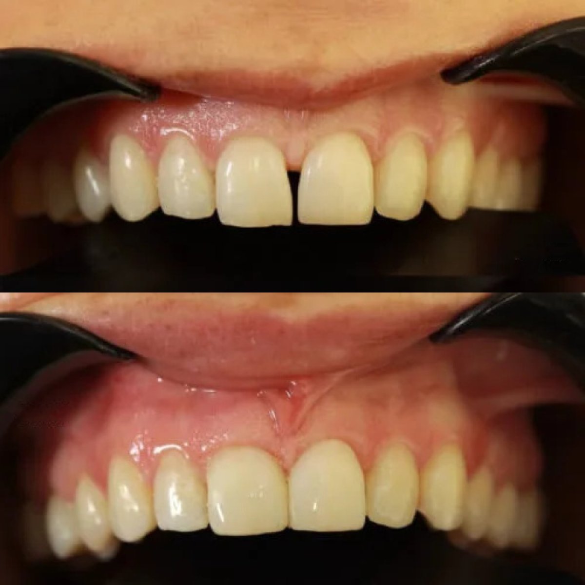 نتائج قبل وبعد ترابط الأسنان في AuraDent Aesthetic Clinic، تحسين جمالية الابتسامة