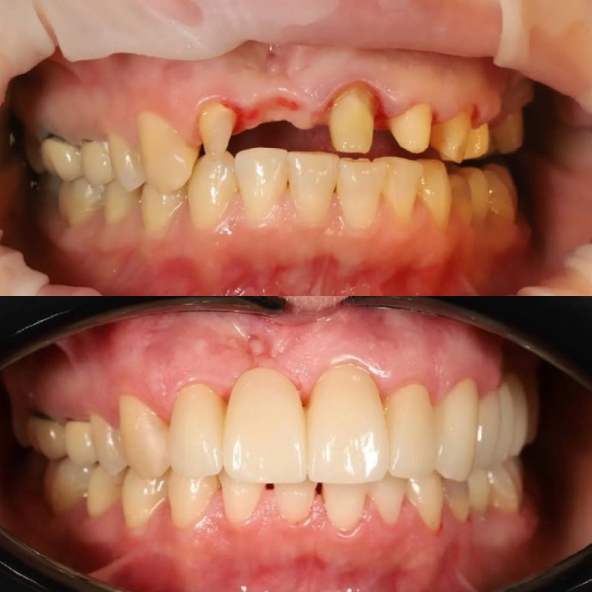 نتيجة قبل وبعد جسر الأسنان المدعوم بالزرعات في Yourdentist.cz، استعادة الابتسامة