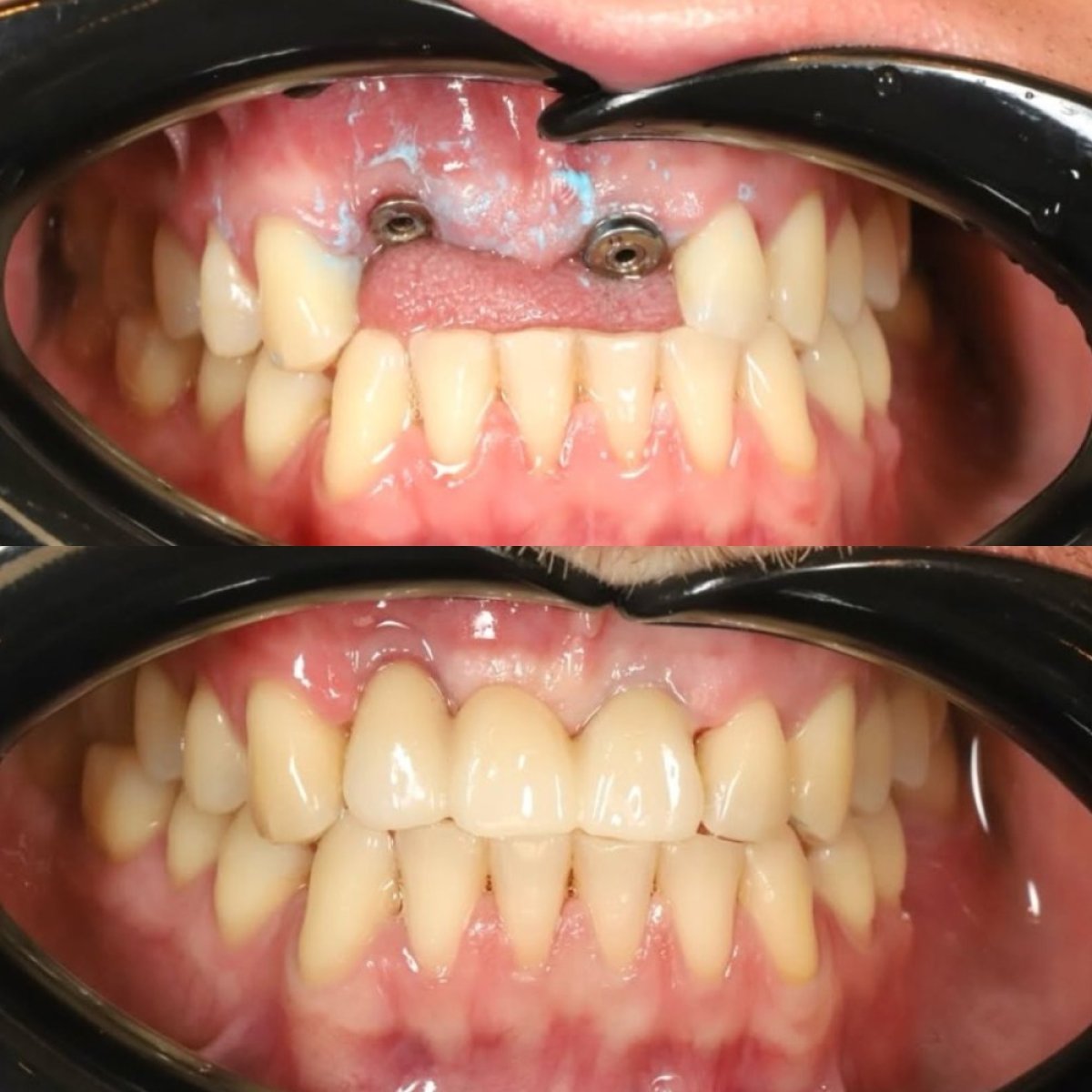 نتائج قبل وبعد جسر الأسنان المدعوم بالزرعات في Yourdentist.cz، ابتسامة مستعادة
