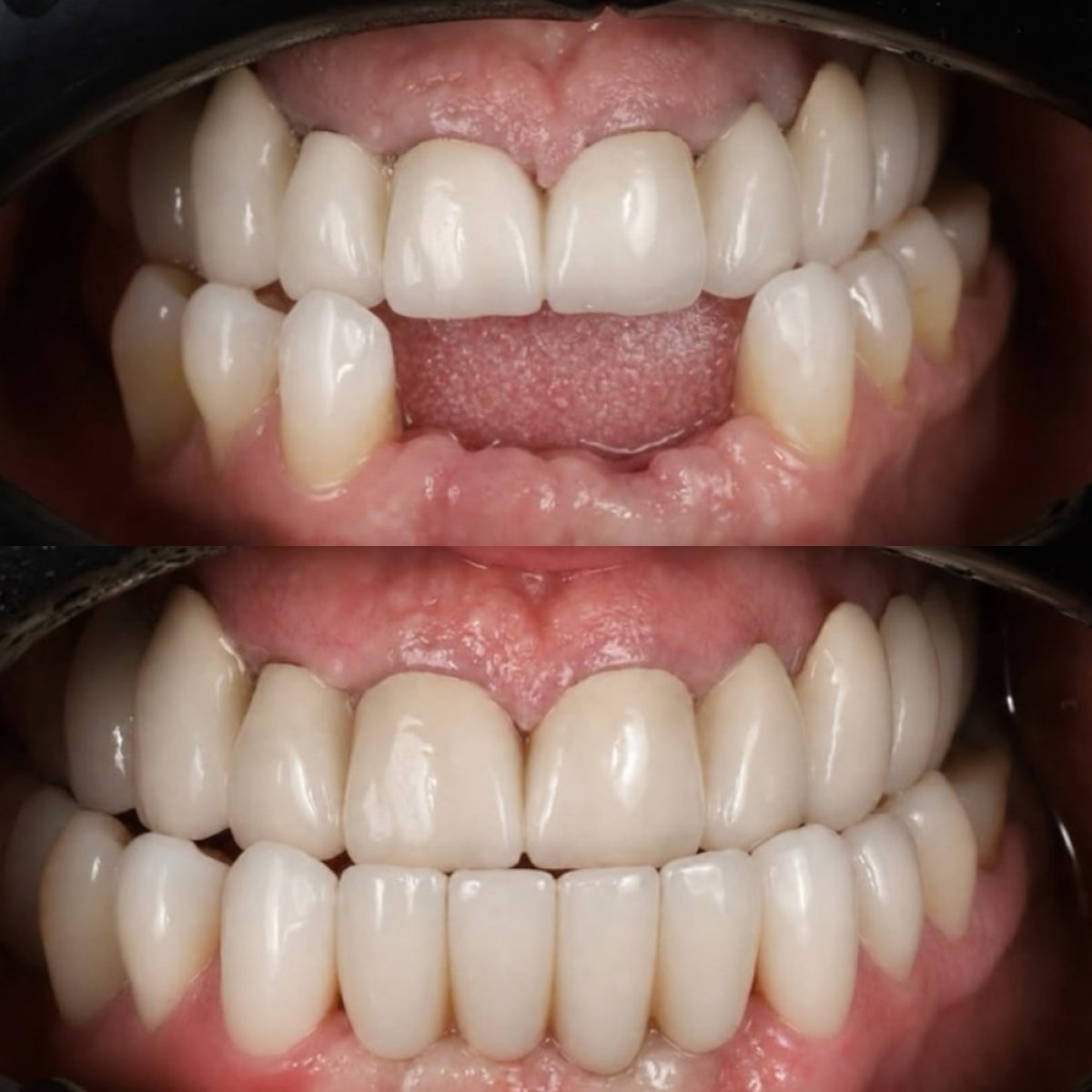 قبل وبعد تركيب تيجان البورسلين في Yourdentist.cz، نتيجة ابتسامة محسنة