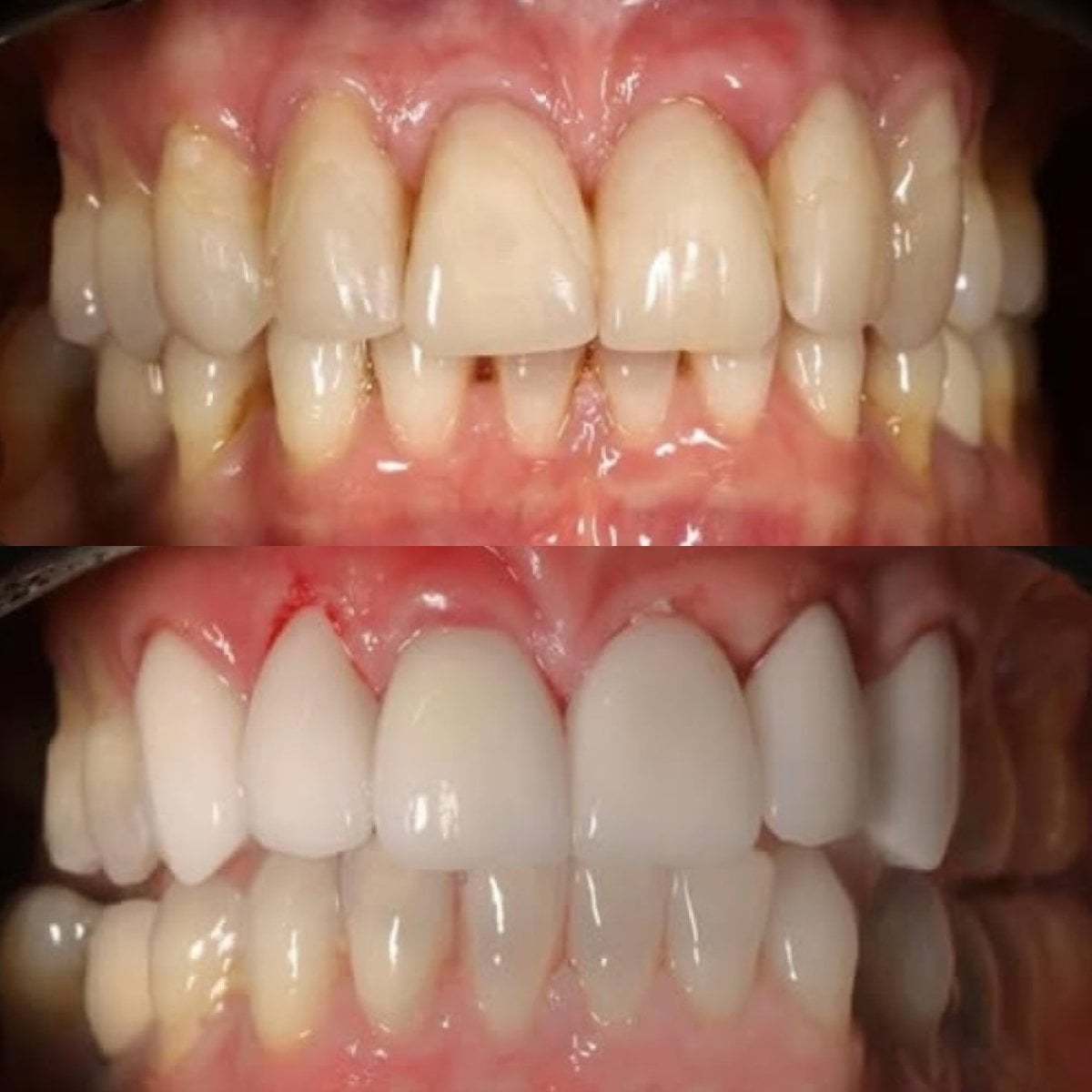 Resultados de carillas de porcelana antes y después en Yourdentist.cz – sonrisa más brillante