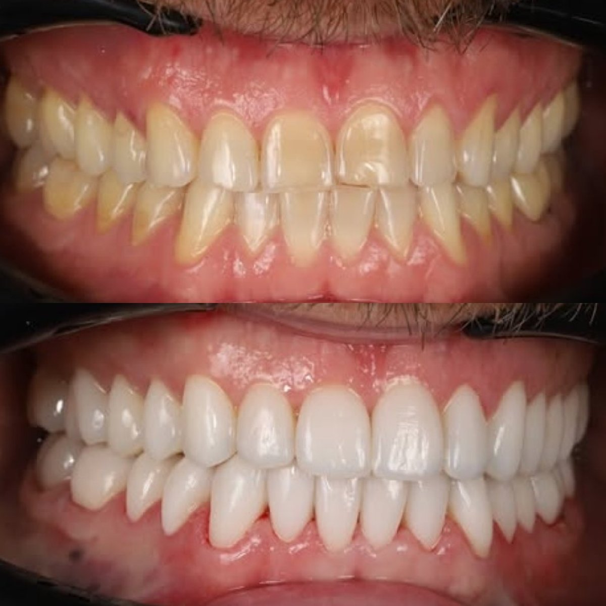 Resultados antes y después de carillas de porcelana en Yourdentist.cz – sonrisa más blanca