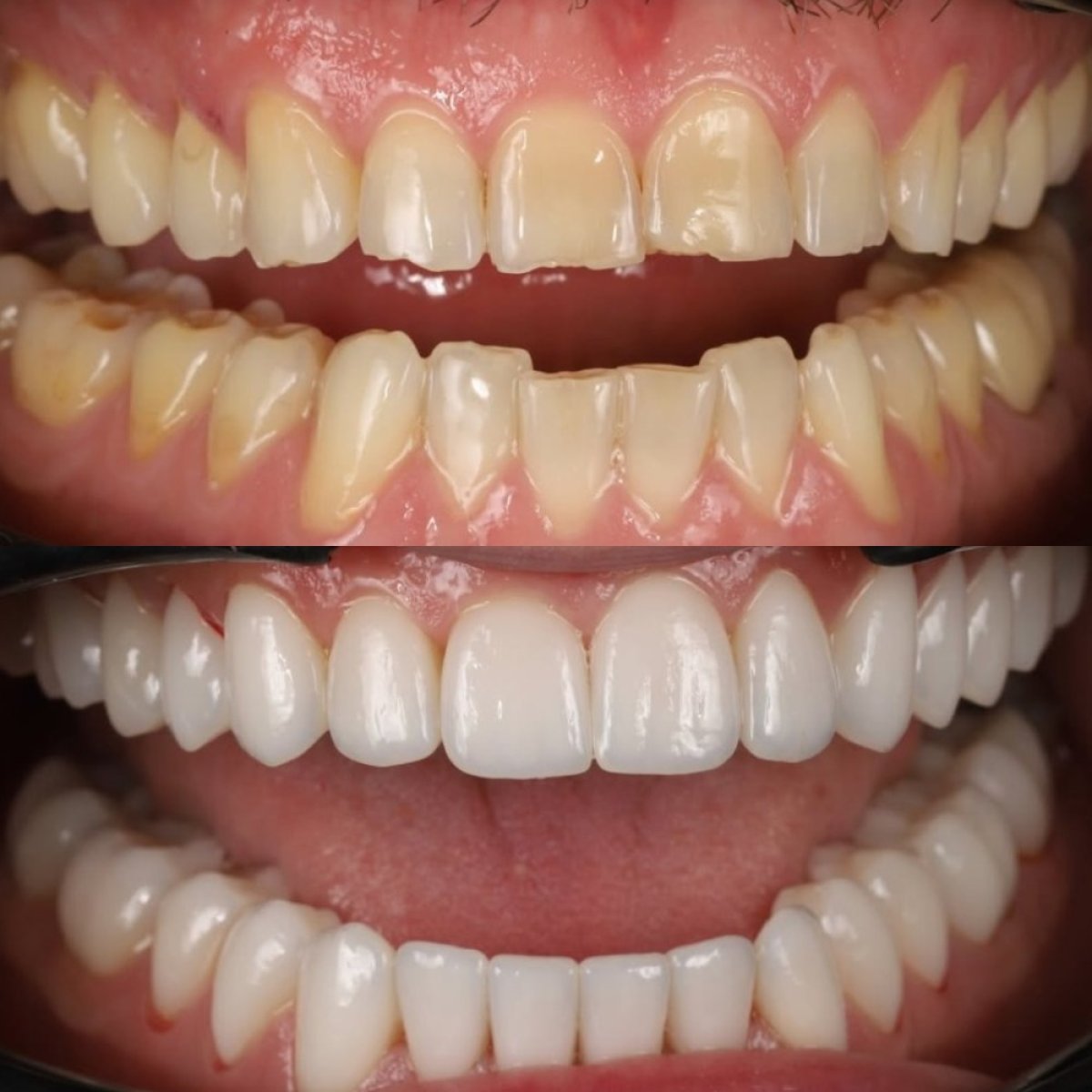 Resultados antes y después de carillas de porcelana en Yourdentist.cz – sonrisa más blanca