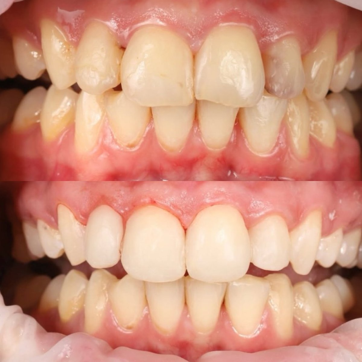نتائج قبل وبعد حشو تجميلي في Yourdentist.cz، تحسين مظهر الأسنان الأمامية