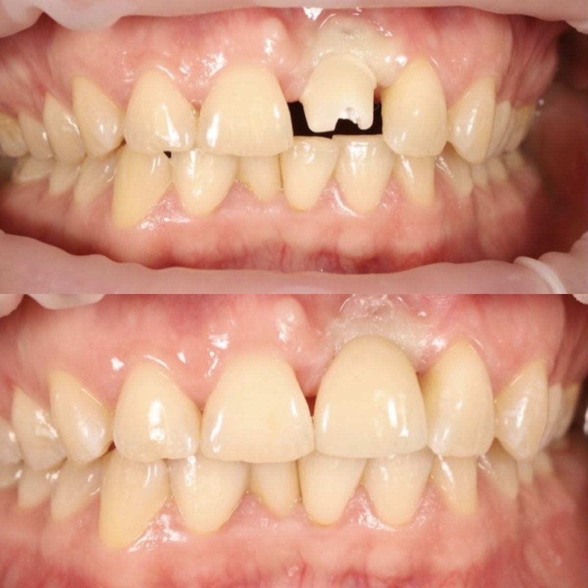 نتيجة زراعة الأسنان قبل وبعد في Yourdentist.cz – استعادة الأسنان الأمامية والابتسامة