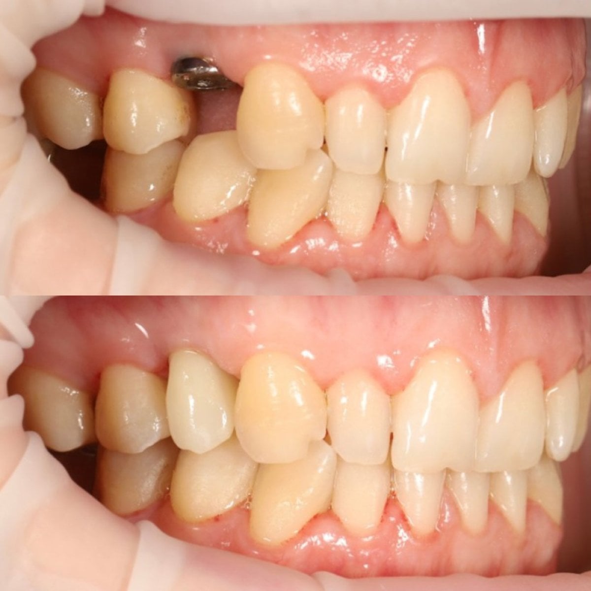 نتائج قبل وبعد زراعة الأسنان مع التاج في Yourdentist.cz – استعادة السن والابتسامة
