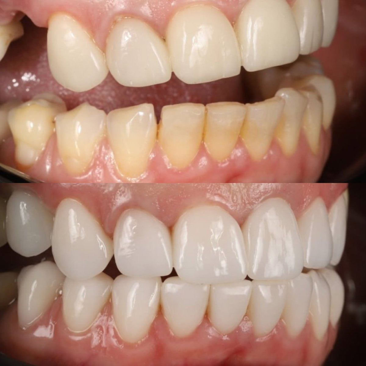 قبل وبعد تركيب تيجان الزركونيا في Yourdentist.cz – نتائج تجميل الابتسامة