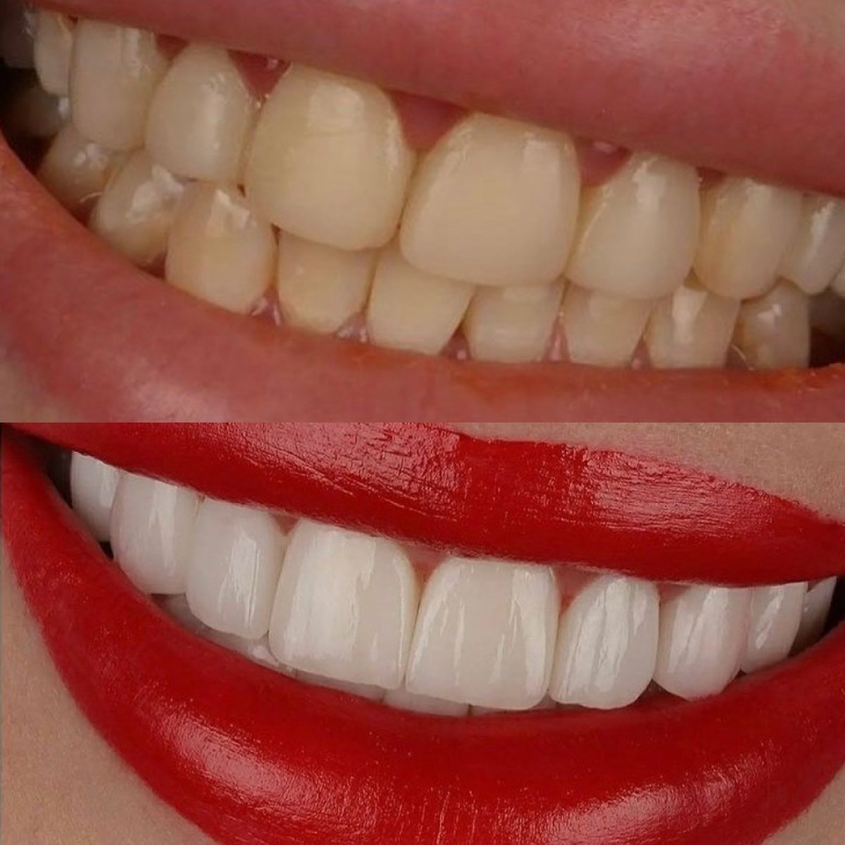 Antes y después de carillas dentales en Hegazy dental clinic, sonrisa más blanca