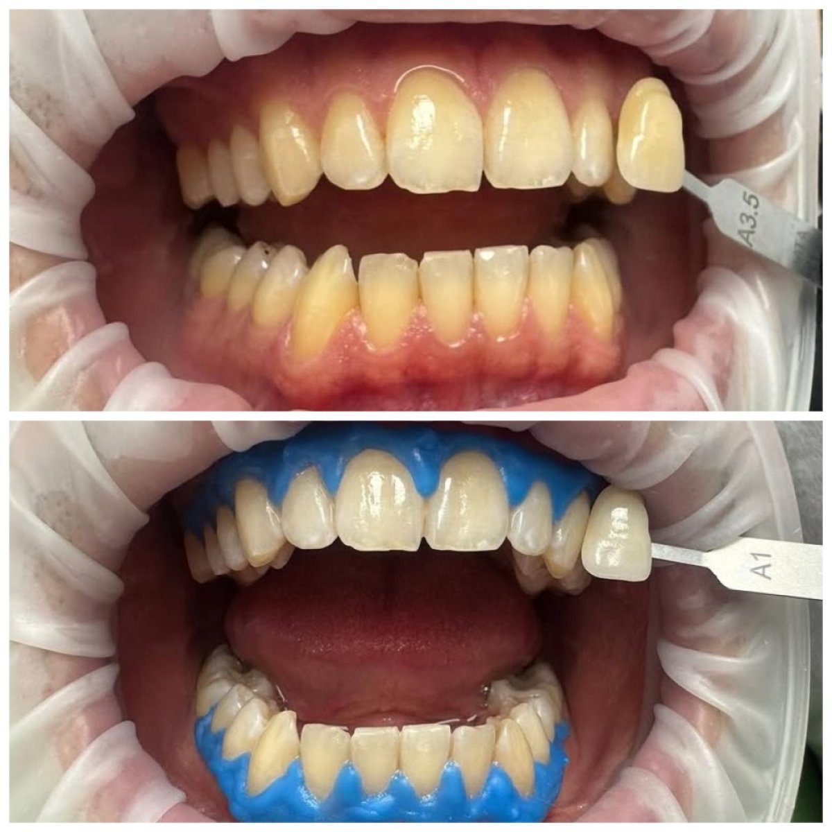 Resultados de blanqueamiento dental antes y después en AllDental Clinic – sonrisa más brillante