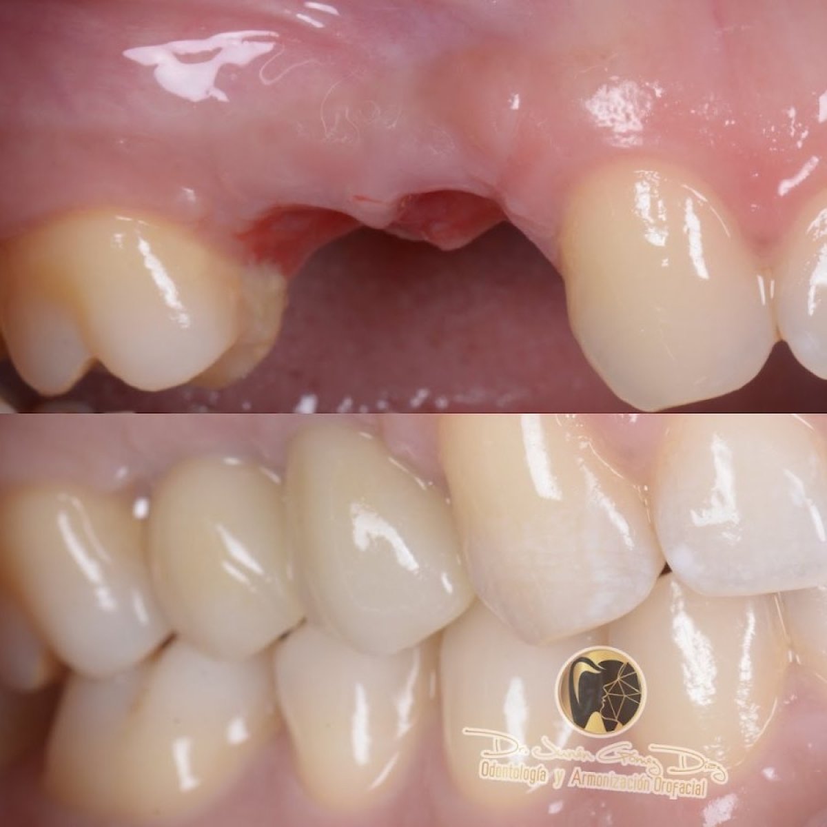 قبل وبعد زراعة الأسنان مع التاج في عيادة Dr. Junen Gómez، ابتسامة طبيعية مستعادة