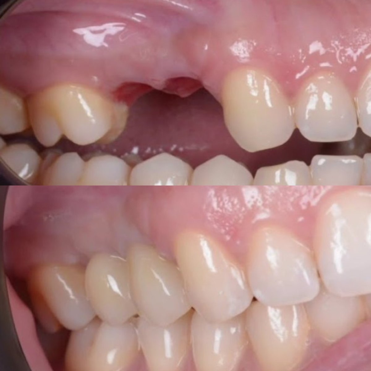 Resultados antes y después de implante dental en Dr. Junen Gómez – sonrisa restaurada