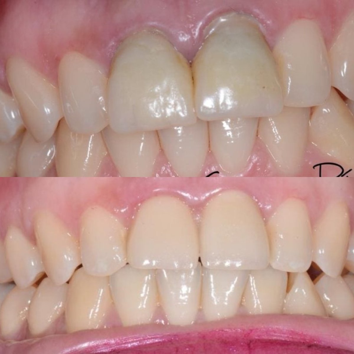 نتائج تبييض الأسنان قبل وبعد في عيادة Dr. Junen Gómez، ابتسامة أكثر إشراقًا