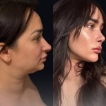 قبل وبعد عملية تجميل الأنف في عيادة Dr.Fatih Çınar، نتيجة تحسين الأنف والملف الجانبي