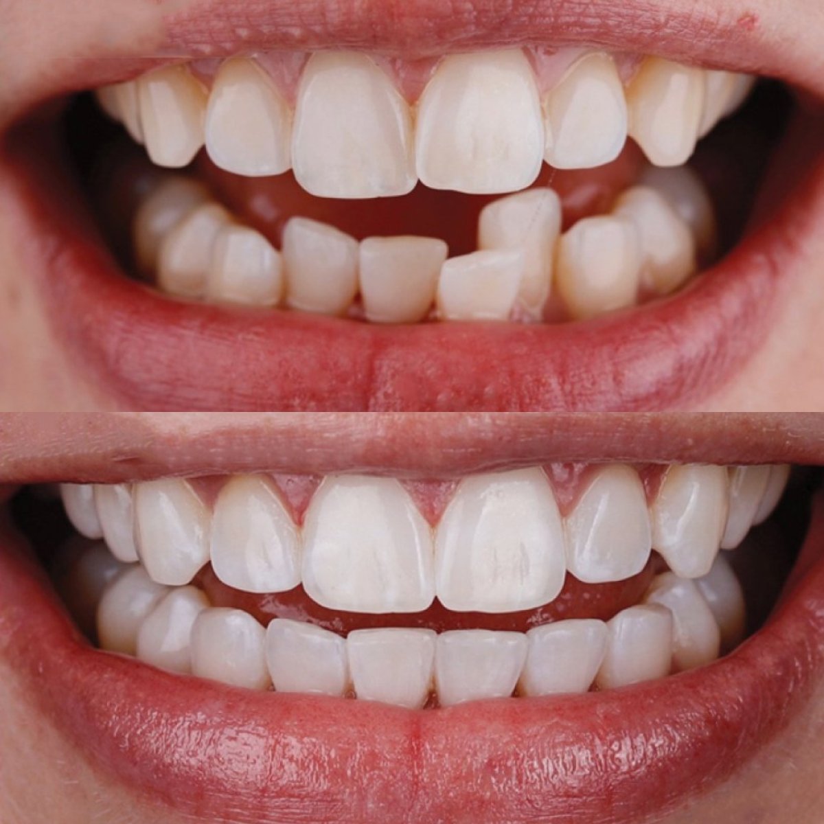 Resultados antes y después de Invisalign en Gremi Clinic: alineación dental y sonrisa mejorada