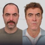 نتائج زراعة الشعر قبل وبعد في عيادة Dr. Said Sadiki، استعادة خط الشعر الممتلئ