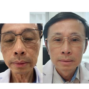 Résultats avant/après thérapie de rajeunissement par cellules souches à ID Clinic Bangkok
