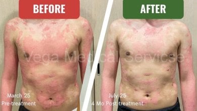 Before and after stem cell therapy for skin condition at Vega Clinic, visible improvement result