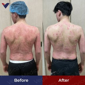 Before and after stem cell therapy for skin condition at Vega Clinic, visible improvement result