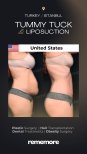 Before and after tummy tuck and liposuction results at Memorial Şişli Hospital, flat abdomen