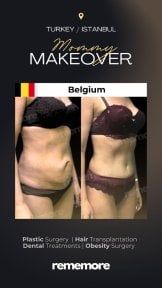 Before and after mommy makeover results at Memorial Şişli Hospital, body contour improvement