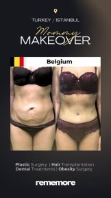 Before and after mommy makeover results at Memorial Şişli Hospital, visible body contouring