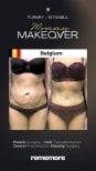 Before and after mommy makeover results at Memorial Şişli Hospital, visible body contouring