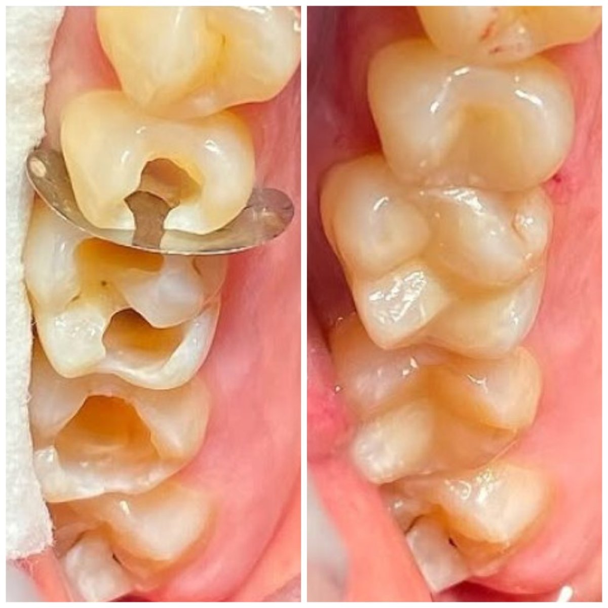 Resultados antes y después del tratamiento de caries en Lekarze w Warszawie, dientes restaurados