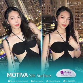 before-after photo monsplasty