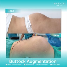 before-after photo buttock-implants