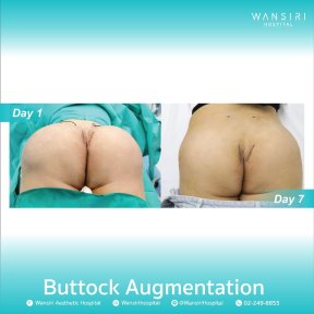 before-after photo buttock-implants