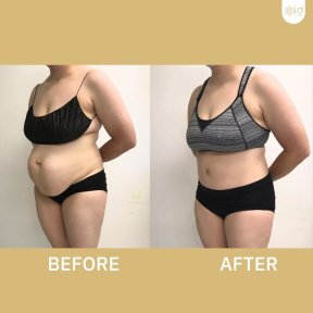 before-after photo tummy-tuck-and-liposuction