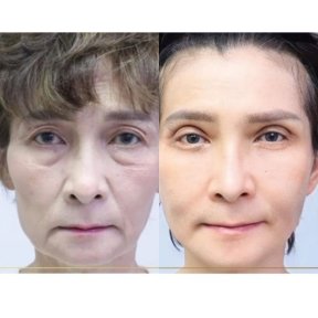 before-after photo deep-plane-facelift