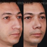 نتائج عملية تجميل الأنف قبل وبعد في عيادة Ayhan Işık Erdal, MD, FACS, FEBOPRAS