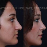 نتائج عملية تجميل الأنف قبل وبعد في عيادة Ayhan Işık Erdal, MD, FACS, FEBOPRAS