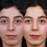 نتائج عملية تجميل الأنف قبل وبعد في عيادة Ayhan Işık Erdal, MD, FACS, FEBOPRAS