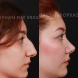 نتائج عملية تجميل الأنف قبل وبعد في عيادة Ayhan Işık Erdal, MD, FACS, FEBOPRAS